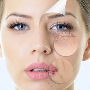 Meso Forte hatóanyagos bőrfeltöltő kezelés, rosacea, pigmentfolt kezelése