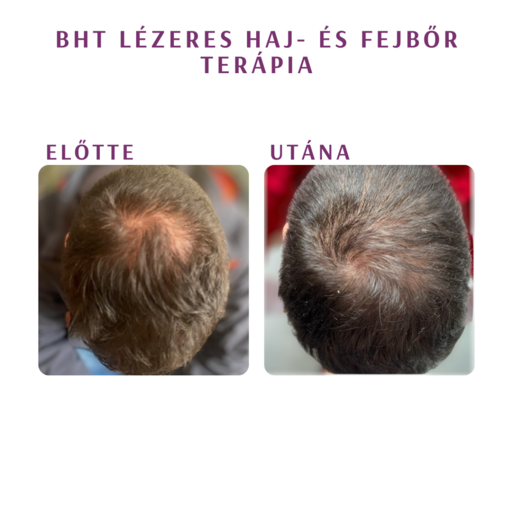 bht lézeres haj- és fejbőr terápia eredménye